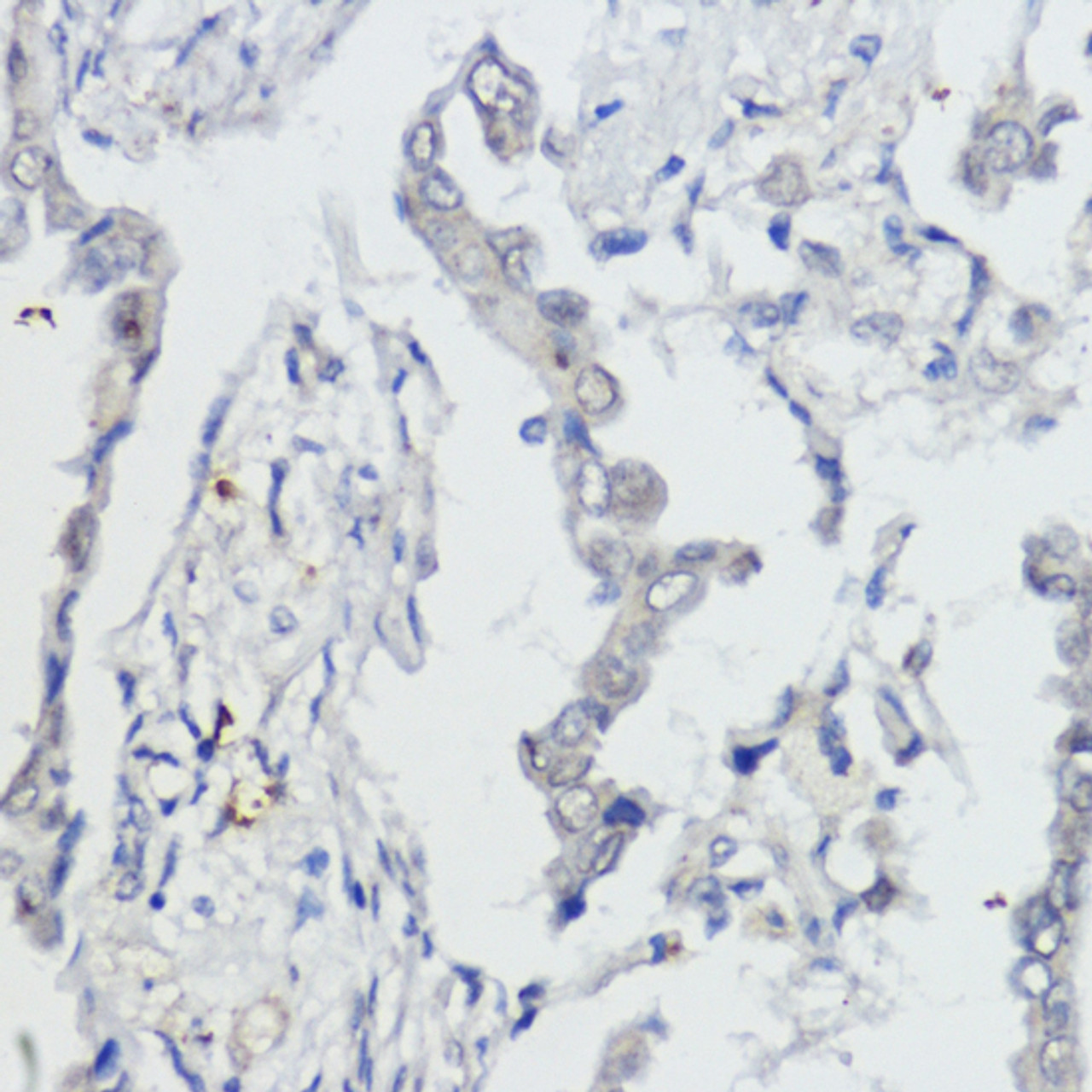 Immunohistochemistry of paraffin-embedded Human lung cancer using AKT Polyclonal Antibody at dilution of  1:100 (40x lens).