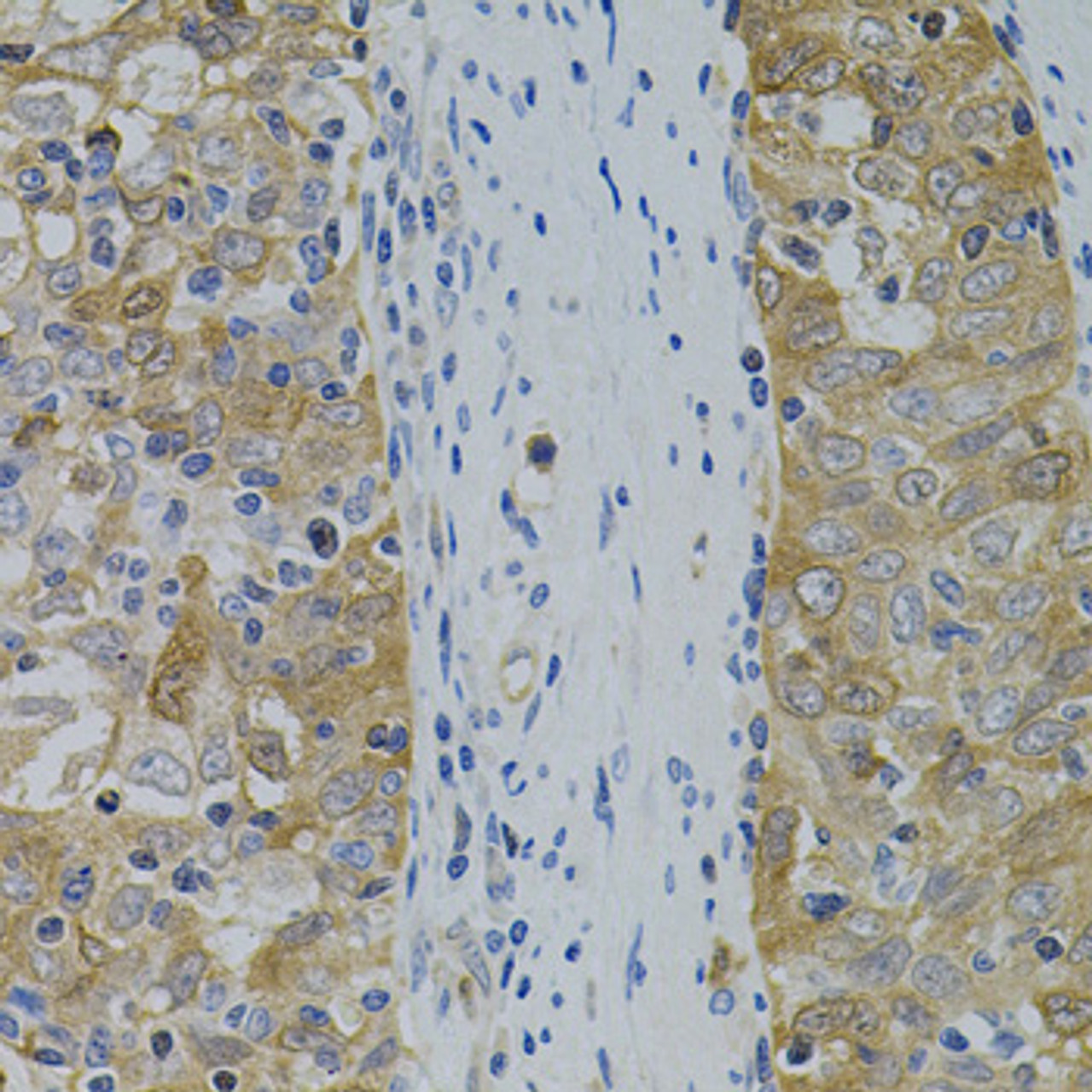Immunohistochemistry of paraffin-embedded Human esophageal cancer using APP Polyclonal Antibody at dilution of  1:100 (40x lens).
