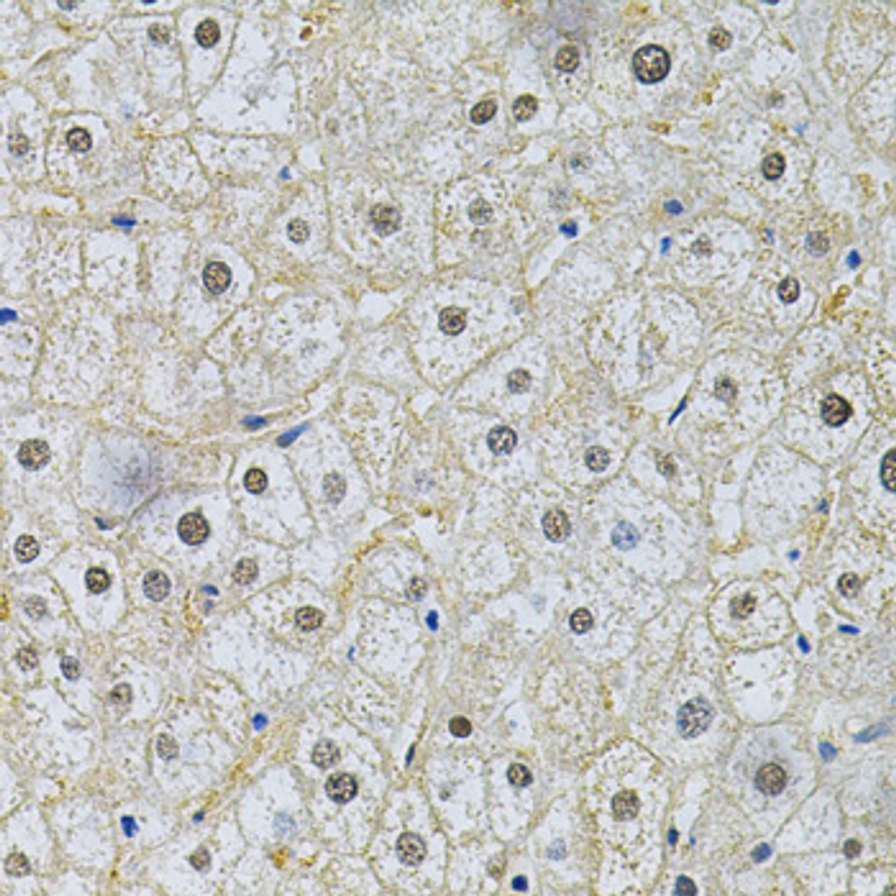 Immunohistochemistry of paraffin-embedded Human liver damage using SQSTM1 / p62 Polyclonal Antibody at dilution of  1:200 (40x lens).