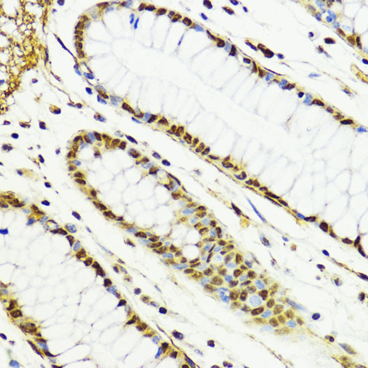 Immunohistochemistry of paraffin-embedded Human colon using CTCF Polyclonal Antibody at dilution of  1:100 (40x lens).