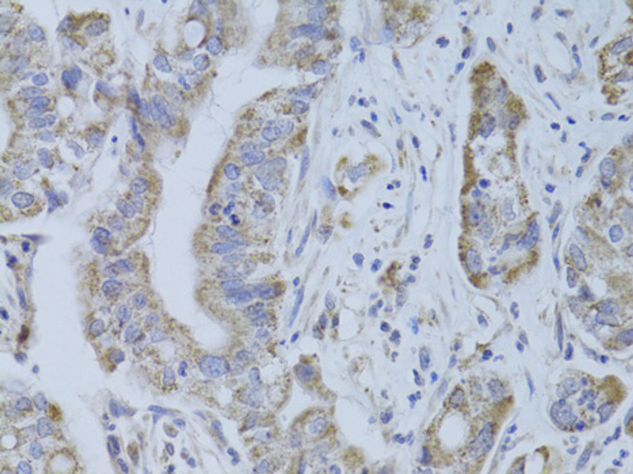 Immunohistochemistry of paraffin-embedded Human liver cancer using CDKN1A Polyclonal Antibody at dilution of  1:100 (40x lens).