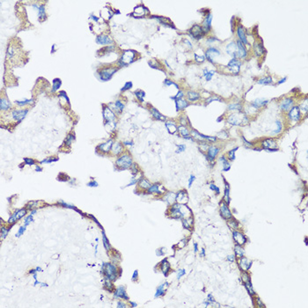 Immunohistochemistry of paraffin-embedded Human lung cancer using SRC Polyclonal Antibody at dilution of  1:100 (40x lens).