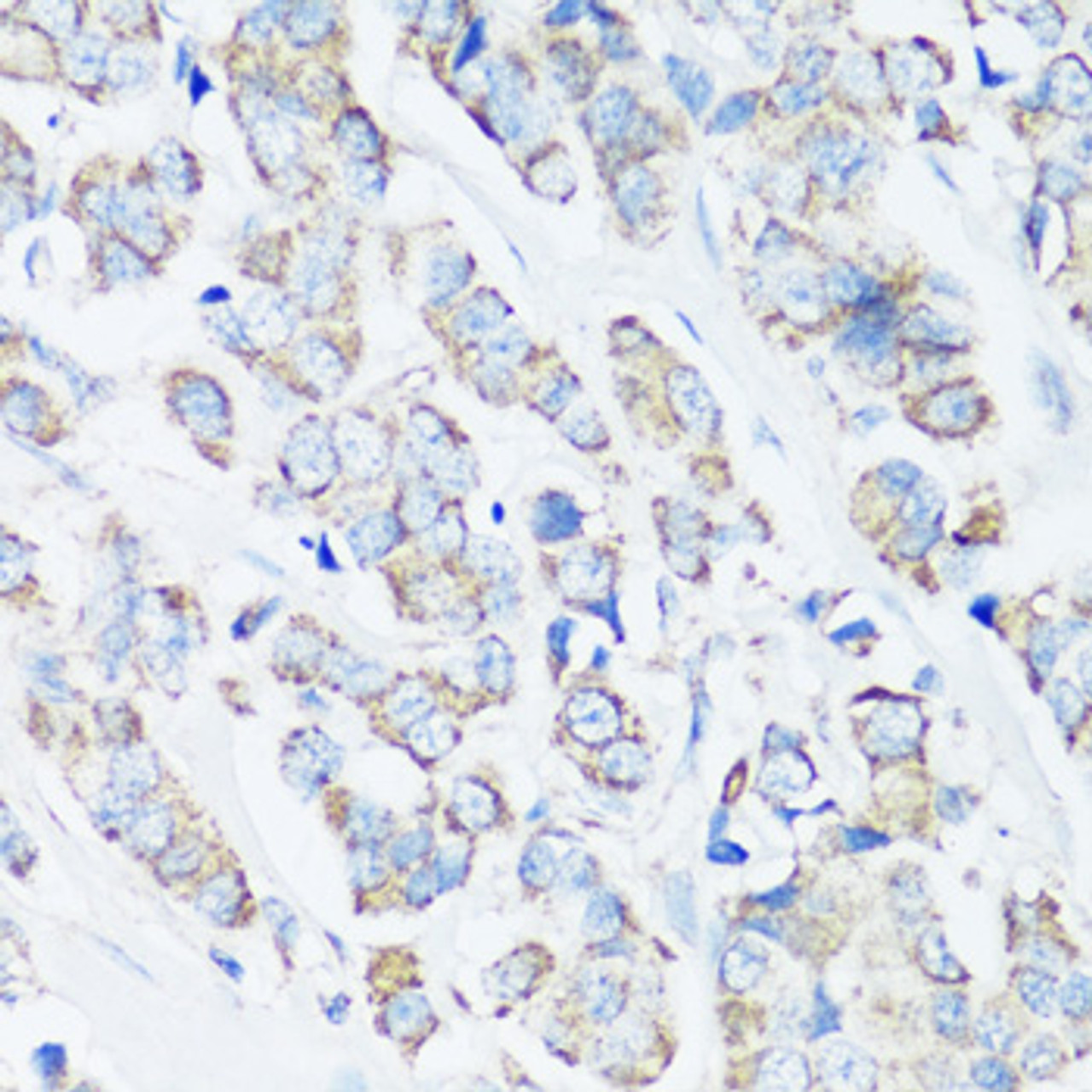 Immunohistochemistry of paraffin-embedded Human breast cancer using SRC Polyclonal Antibody at dilution of  1:100 (40x lens).