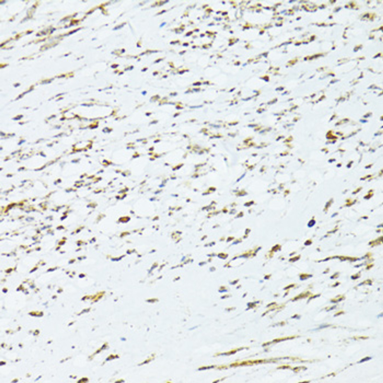 Immunohistochemistry of paraffin-embedded Human uterine cancer using TRIM15 Polyclonal Antibody at dilution of  1:100 (40x lens).