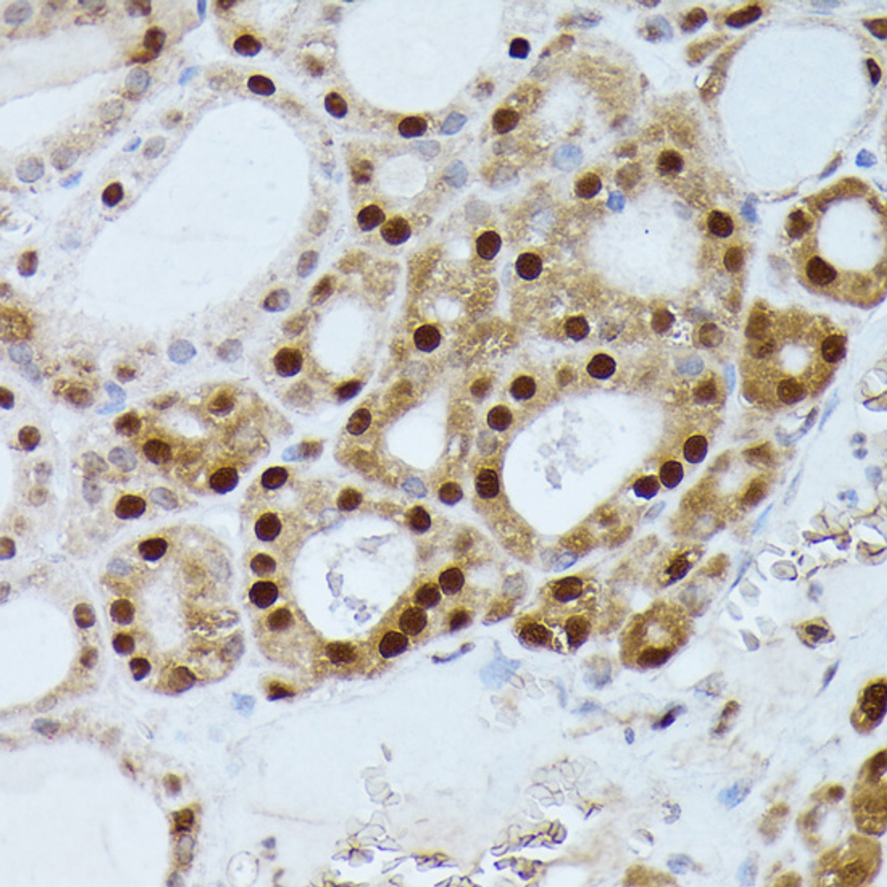 Immunohistochemistry of paraffin-embedded Human thyroid cancer using GADD45A Polyclonal Antibody at dilution of  1:100 (40x lens).