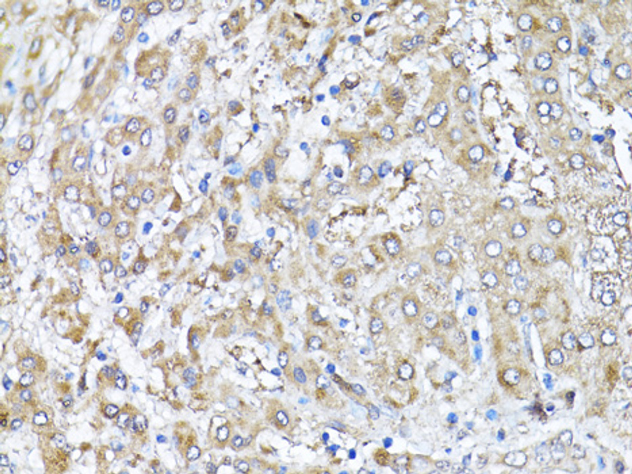 Immunohistochemistry of paraffin-embedded Human liver using Snail Polyclonal Antibody at dilution of  1:100 (40x lens).