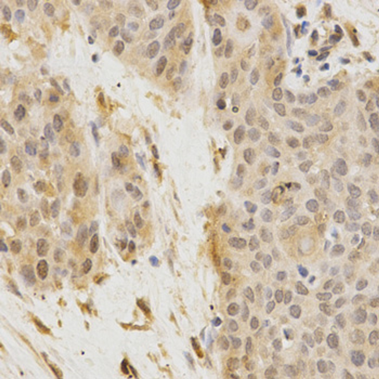 Immunohistochemistry of paraffin-embedded Human esophageal cancer using GGA2 Polyclonal Antibody at dilution of  1:200 (40x lens).