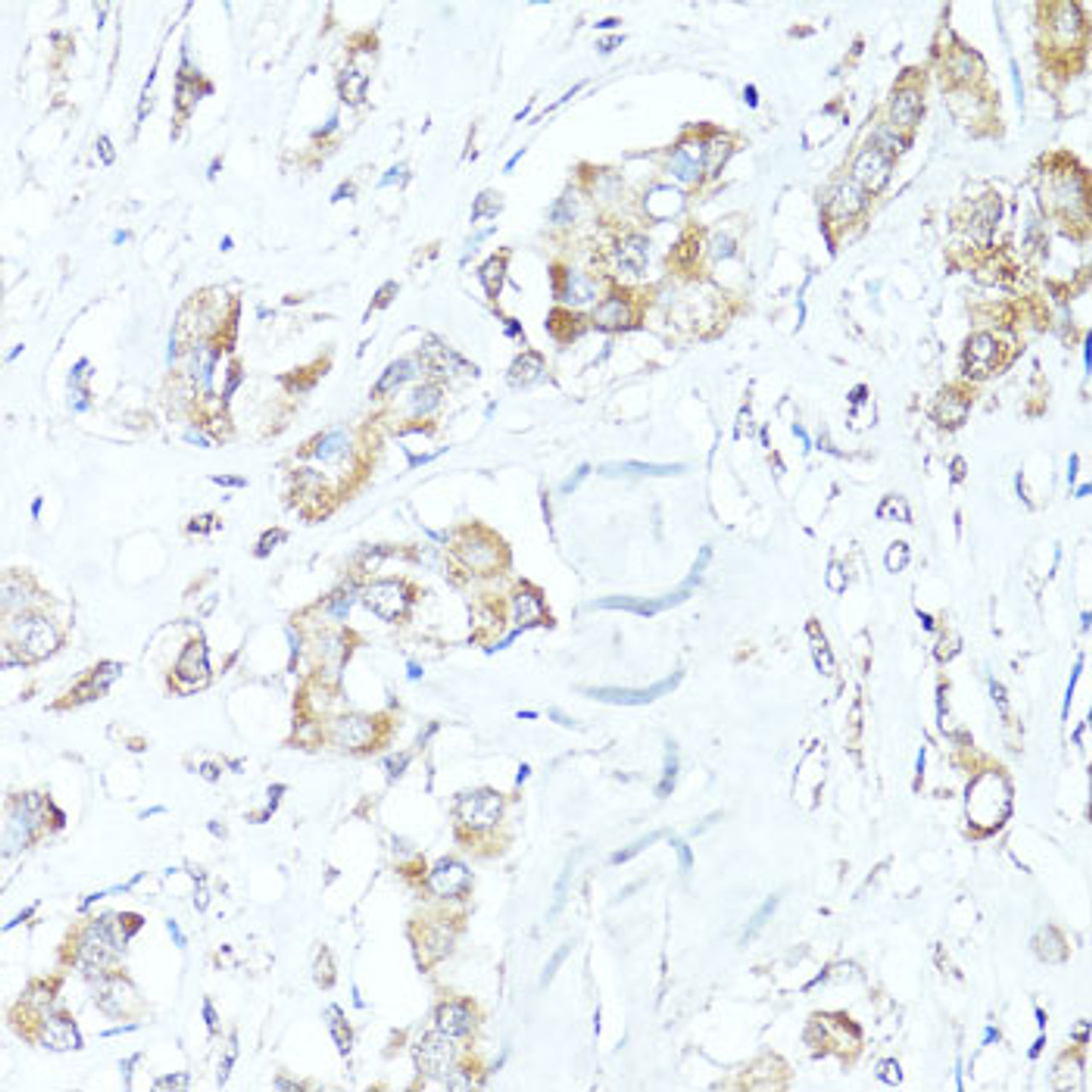Immunohistochemistry of paraffin-embedded Human breast cancer using BAX Polyclonal Antibody at dilution of  1:100 (40x lens).