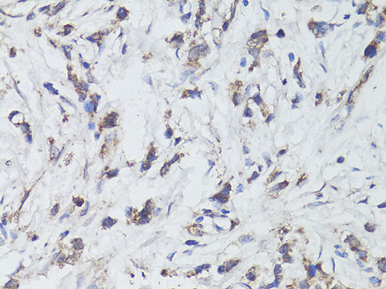 Immunohistochemistry of paraffin-embedded Human gastric cancer using TrkB Polyclonal Antibody at dilution of  1:200 (40x lens).