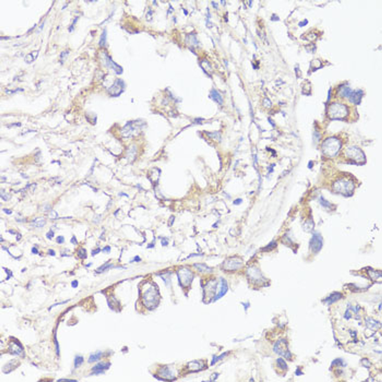 Immunohistochemistry of paraffin-embedded Human lung cancer using KL Polyclonal Antibody at dilution of  1:200 (40x lens).