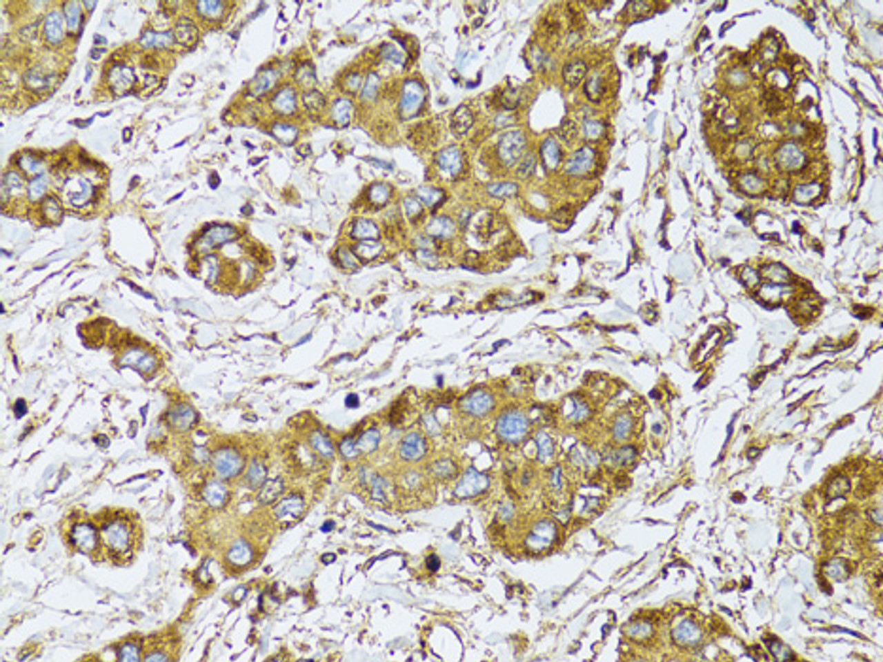 Immunohistochemistry of paraffin-embedded Human liver cancer using UGDH Polyclonal Antibody at dilution of  1:100 (40x lens).