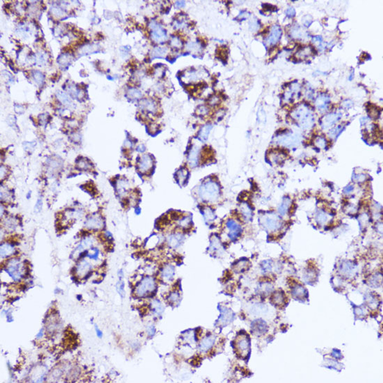 Immunohistochemistry of paraffin-embedded Human liver cancer using SHMT2 Polyclonal Antibody at dilution of  1:100 (40x lens).