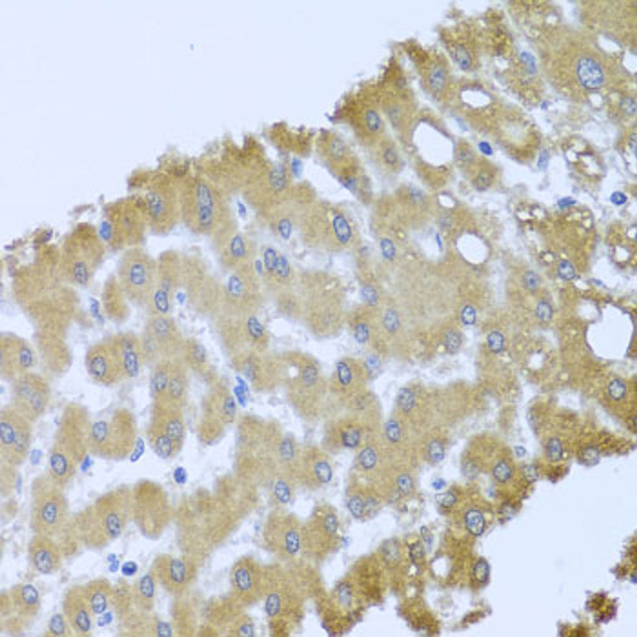 Immunohistochemistry of paraffin-embedded Human liver damage using ACP1 Polyclonal Antibody at dilution of  1:100 (40x lens).