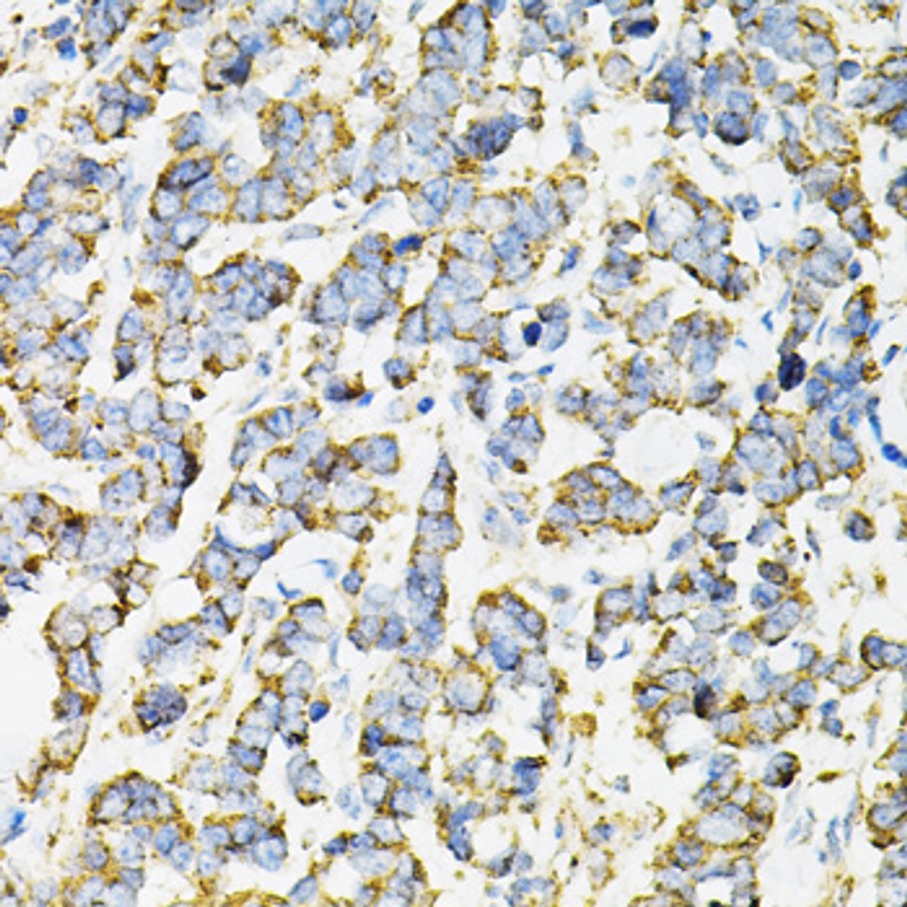 Immunohistochemistry of paraffin-embedded Human lung cancer using ADSS Polyclonal Antibody at dilution of  1:100 (40x lens).