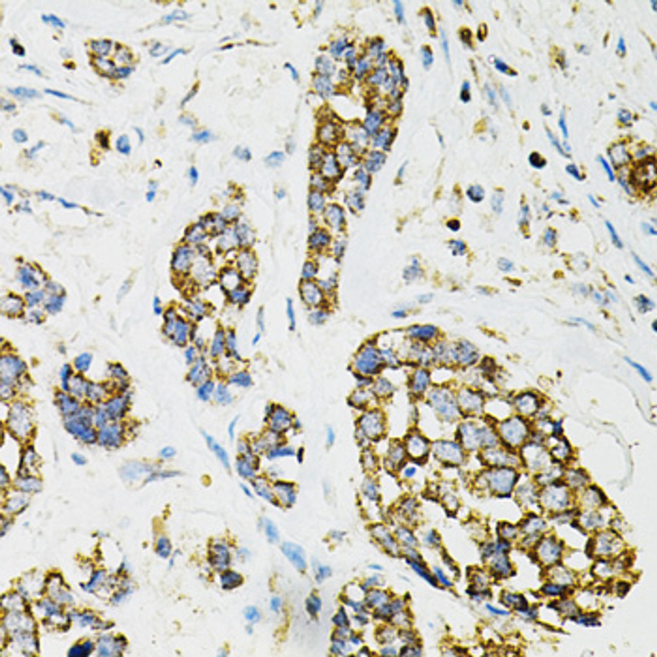 Immunohistochemistry of paraffin-embedded Human esophageal cancer using ADSS Polyclonal Antibody at dilution of  1:100 (40x lens).