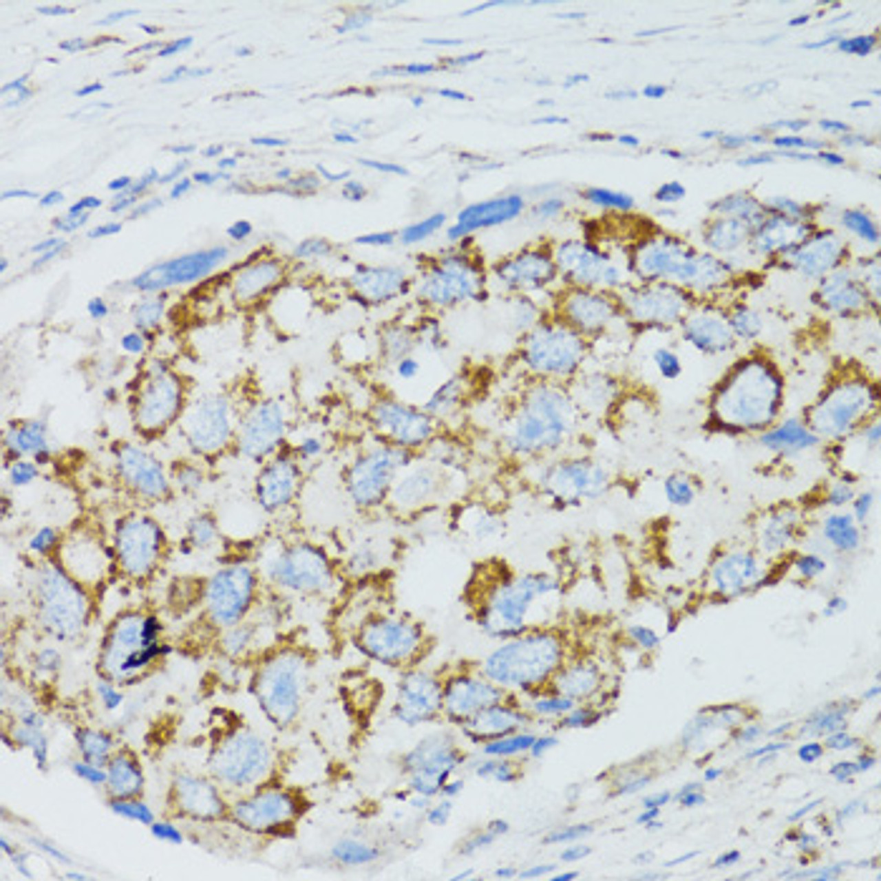 Immunohistochemistry of paraffin-embedded Human breast cancer using C1 Inactivator Polyclonal Antibody at dilution of  1:100 (40x lens).