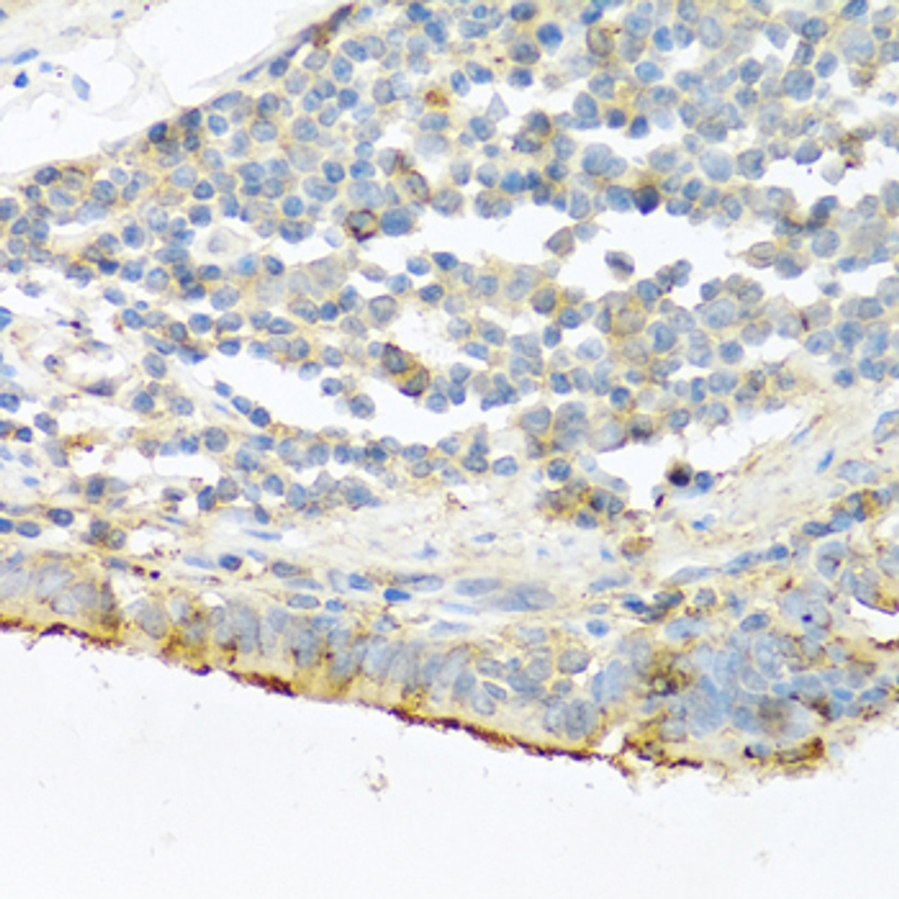 Immunohistochemistry of paraffin-embedded Human lung cancer using PRSS1 Polyclonal Antibody at dilution of  1:100 (40x lens).