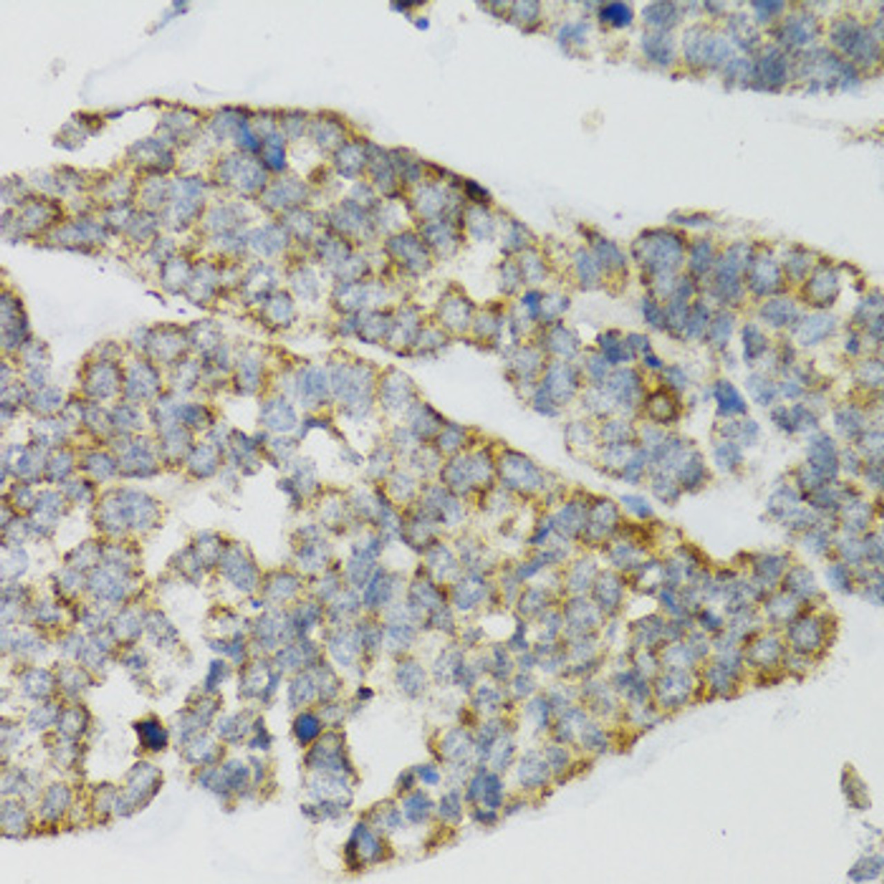 Immunohistochemistry of paraffin-embedded Human esophageal cancer using PI3 Polyclonal Antibody at dilution of  1:100 (40x lens).
