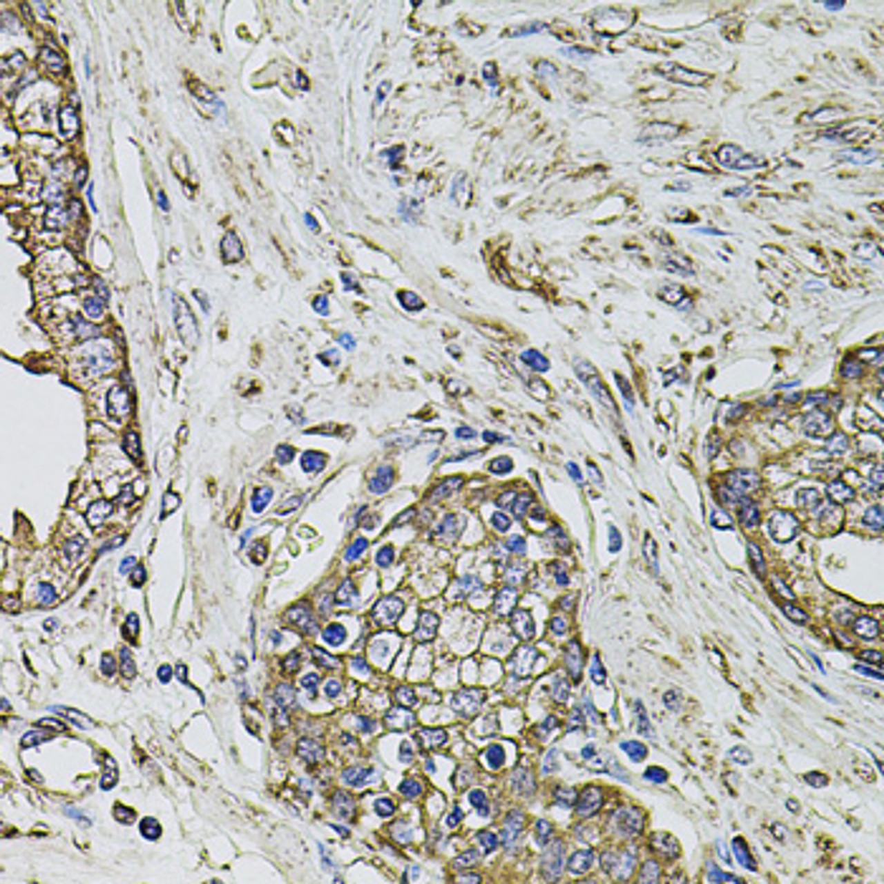 Immunohistochemistry of paraffin-embedded Human prostate using PTHLH Polyclonal Antibody at dilution of  1:100 (40x lens).