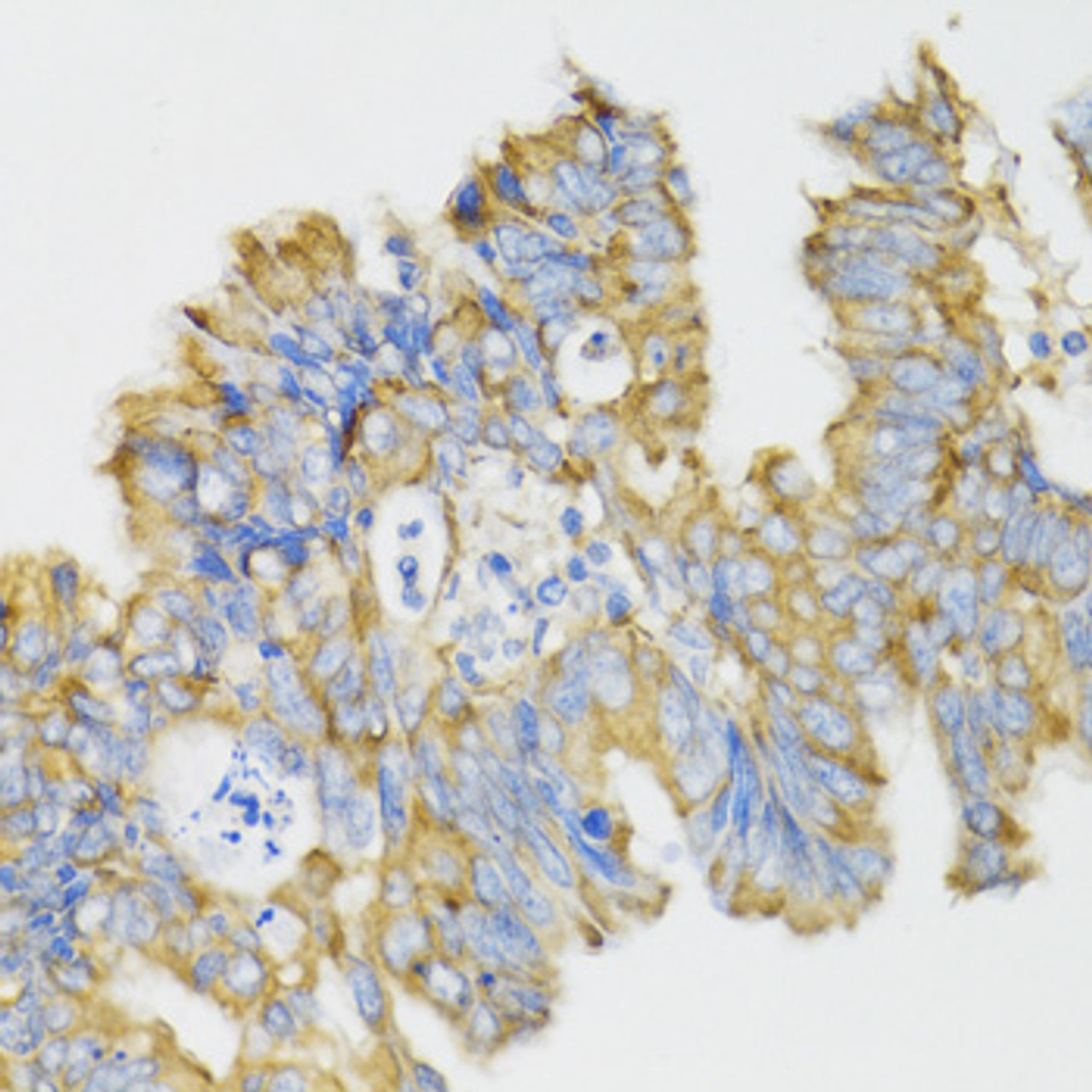 Immunohistochemistry of paraffin-embedded Human rectal cancer using GHRL Polyclonal Antibody at dilution of  1:100 (40x lens).