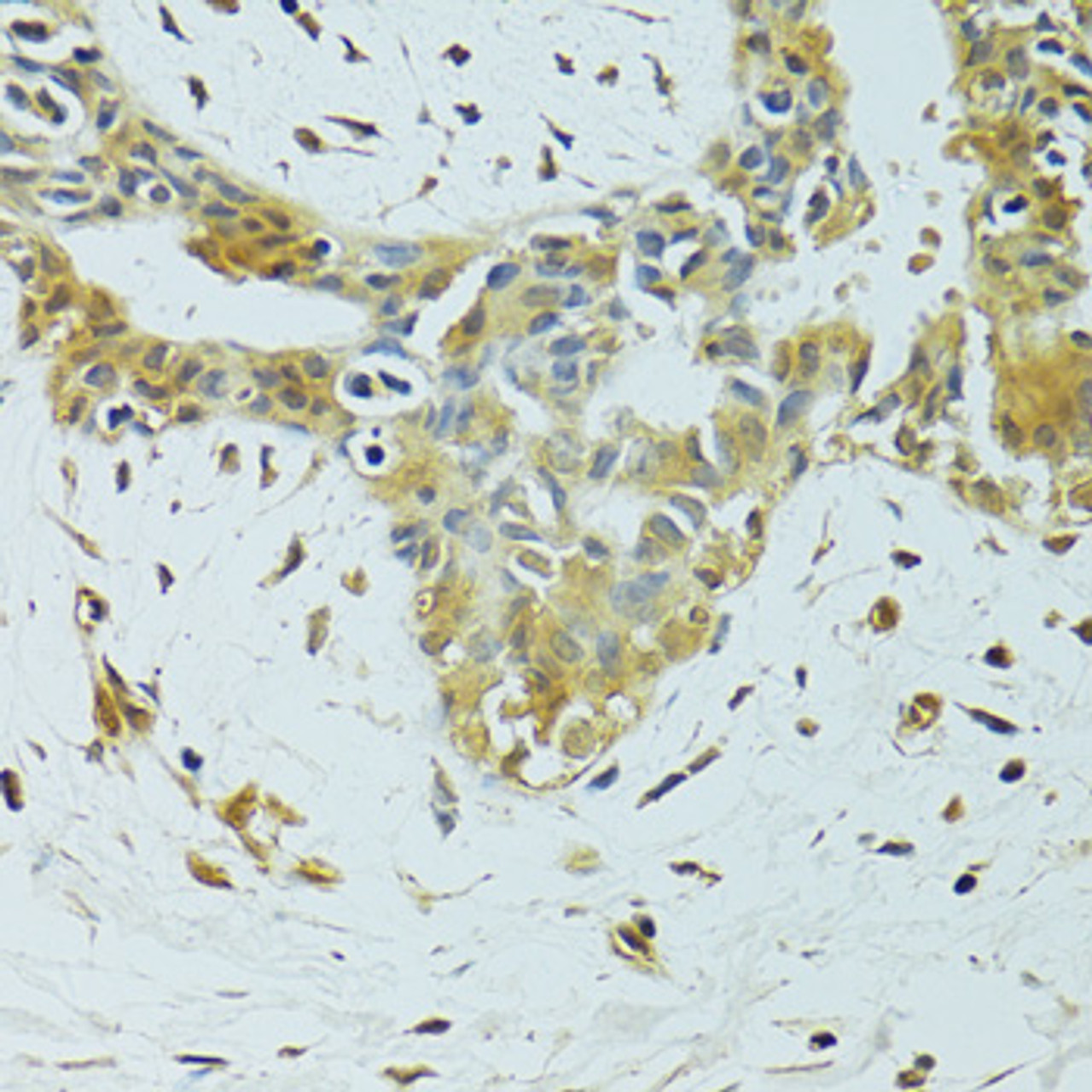 Immunohistochemistry of paraffin-embedded Human breast cancer using METTL13 Polyclonal Antibody at dilution of  1:100 (40x lens).