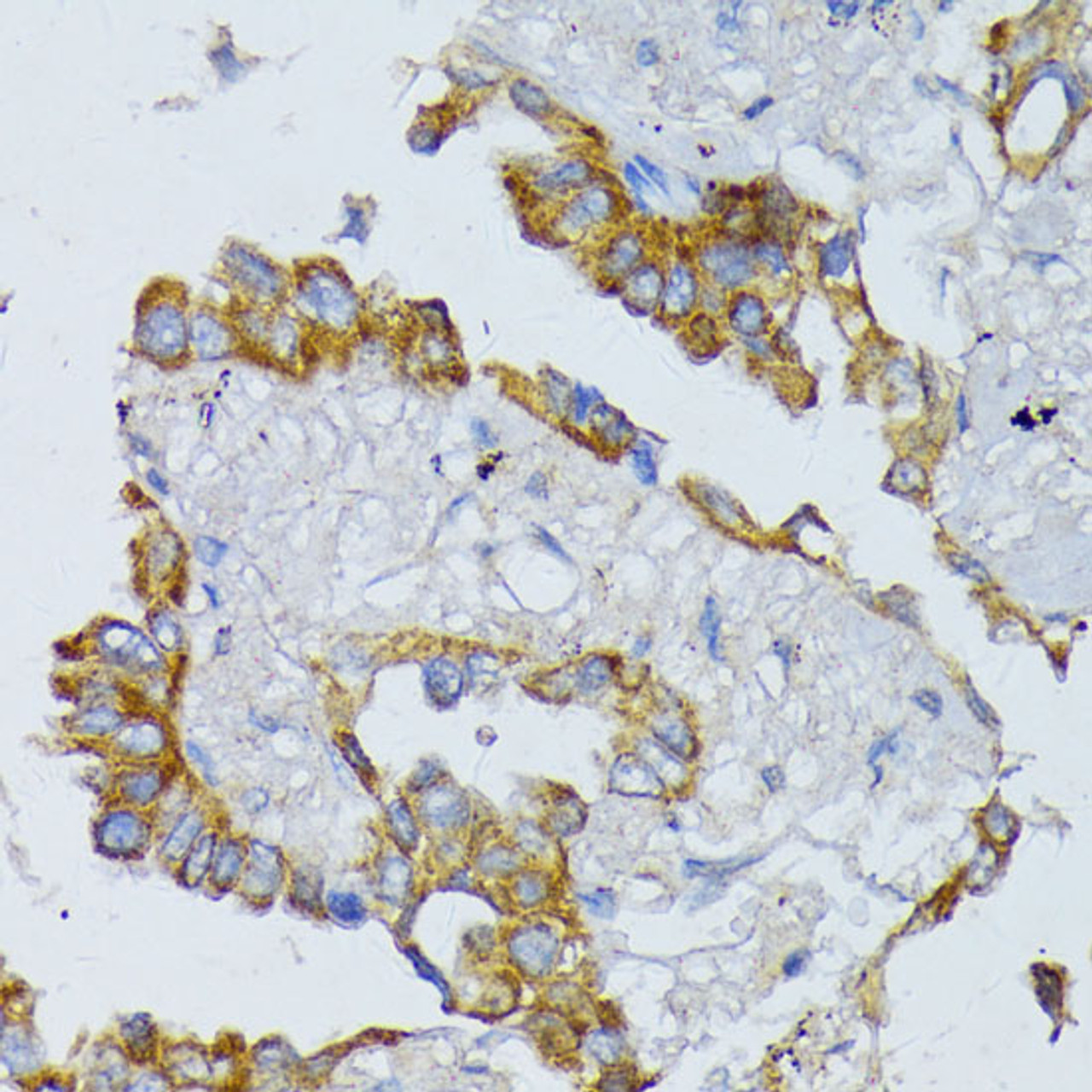 Immunohistochemistry of paraffin-embedded Human lung cancer using ACADL Polyclonal Antibody at dilution of  1:100 (40x lens).