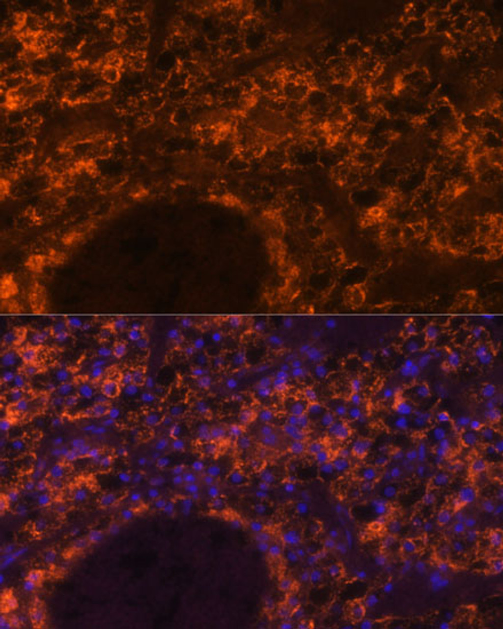 Immunofluorescence analysis of Human kidney cancer using SLC7A9 Polyclonal Antibody at dilution of  1:100. Blue: DAPI for nuclear staining.