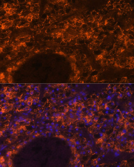 Immunofluorescence analysis of Human kidney cancer using SLC7A9 Polyclonal Antibody at dilution of  1:100. Blue: DAPI for nuclear staining.