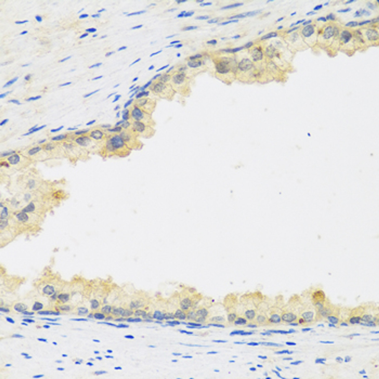 Immunohistochemistry of paraffin-embedded Human prostate using LIF Polyclonal Antibody at dilution of  1:100 (40x lens).