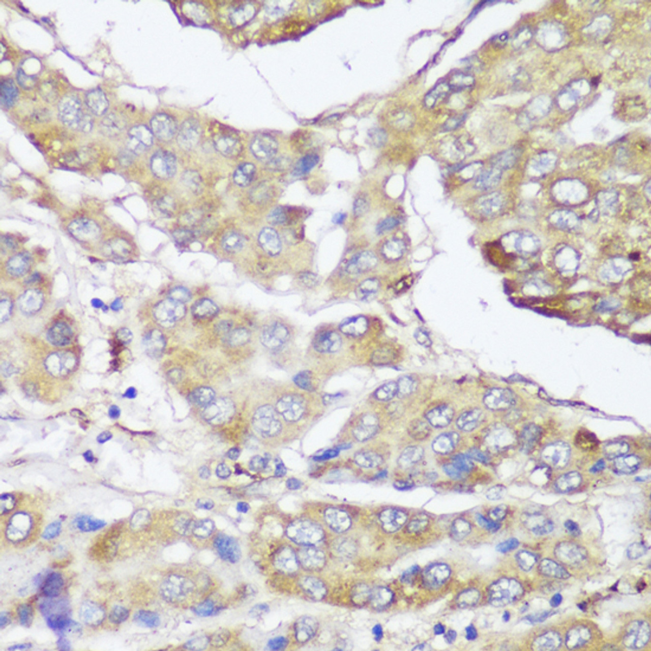 Immunohistochemistry of paraffin-embedded Human liver cancer using FKBP10 Polyclonal Antibody at dilution of  1:150 (40x lens).