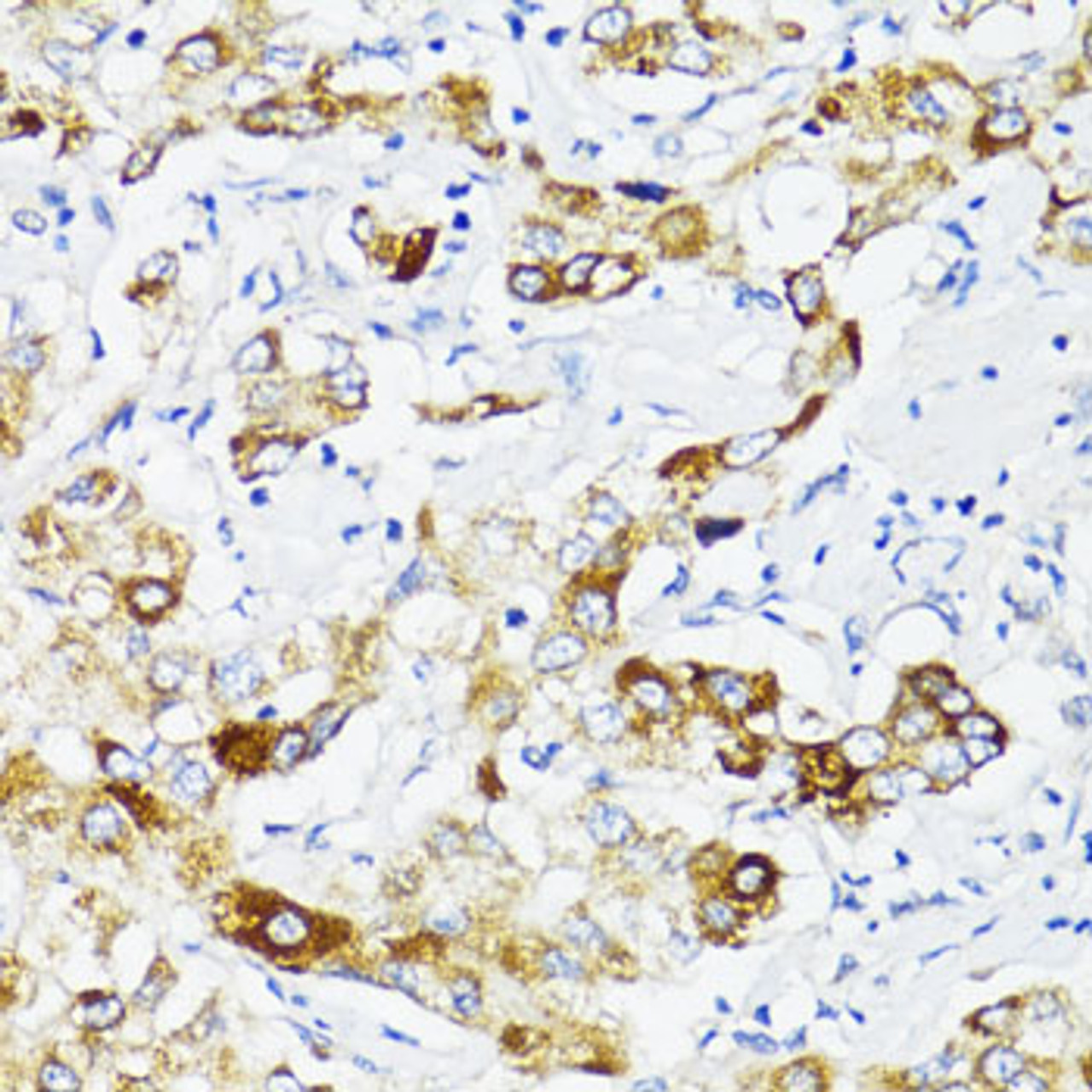 Immunohistochemistry of paraffin-embedded Human liver cancer using Fibronectin Polyclonal Antibody at dilution of  1:100 (40x lens).