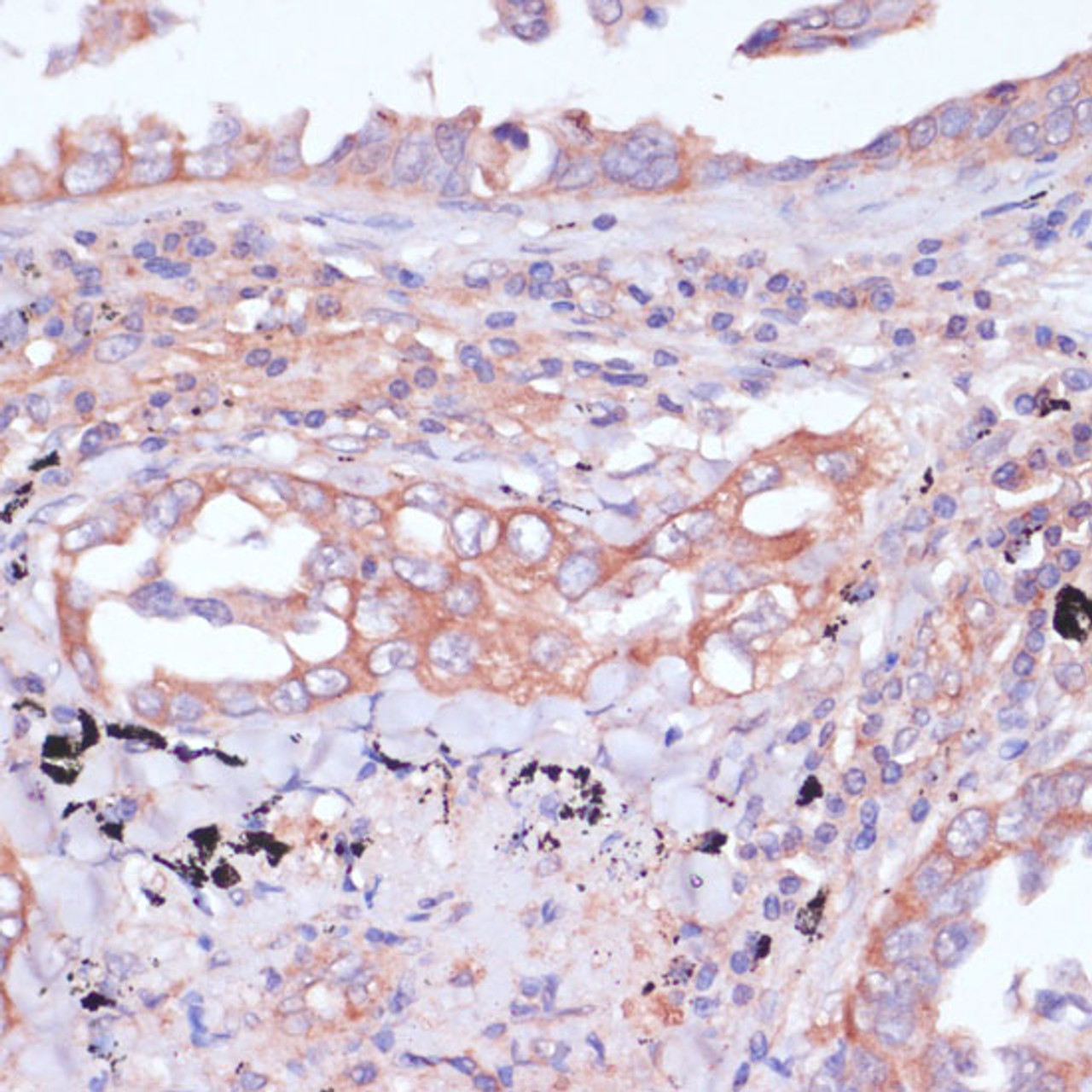 Immunohistochemistry of paraffin-embedded Human lung cancer using RPL32 Polyclonal Antibody at dilution of  1:100 (40x lens).