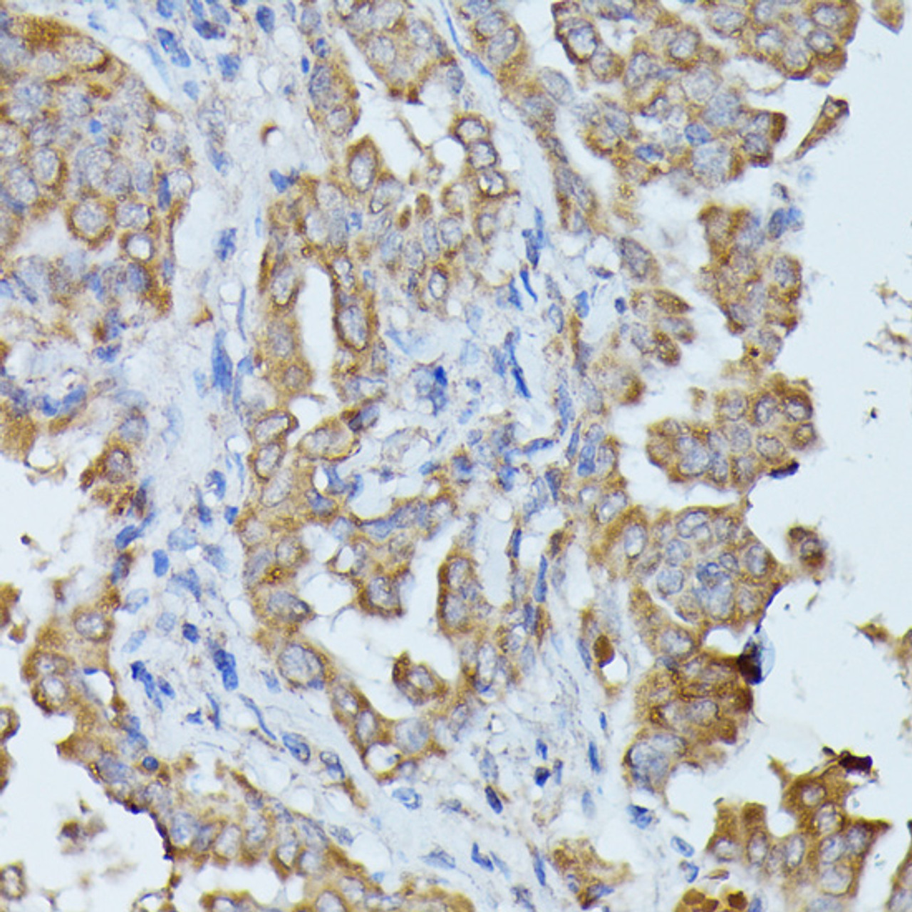 Immunohistochemistry of paraffin-embedded Human thyroid cancer using HAL Polyclonal Antibody at dilution of  1:100 (40x lens).