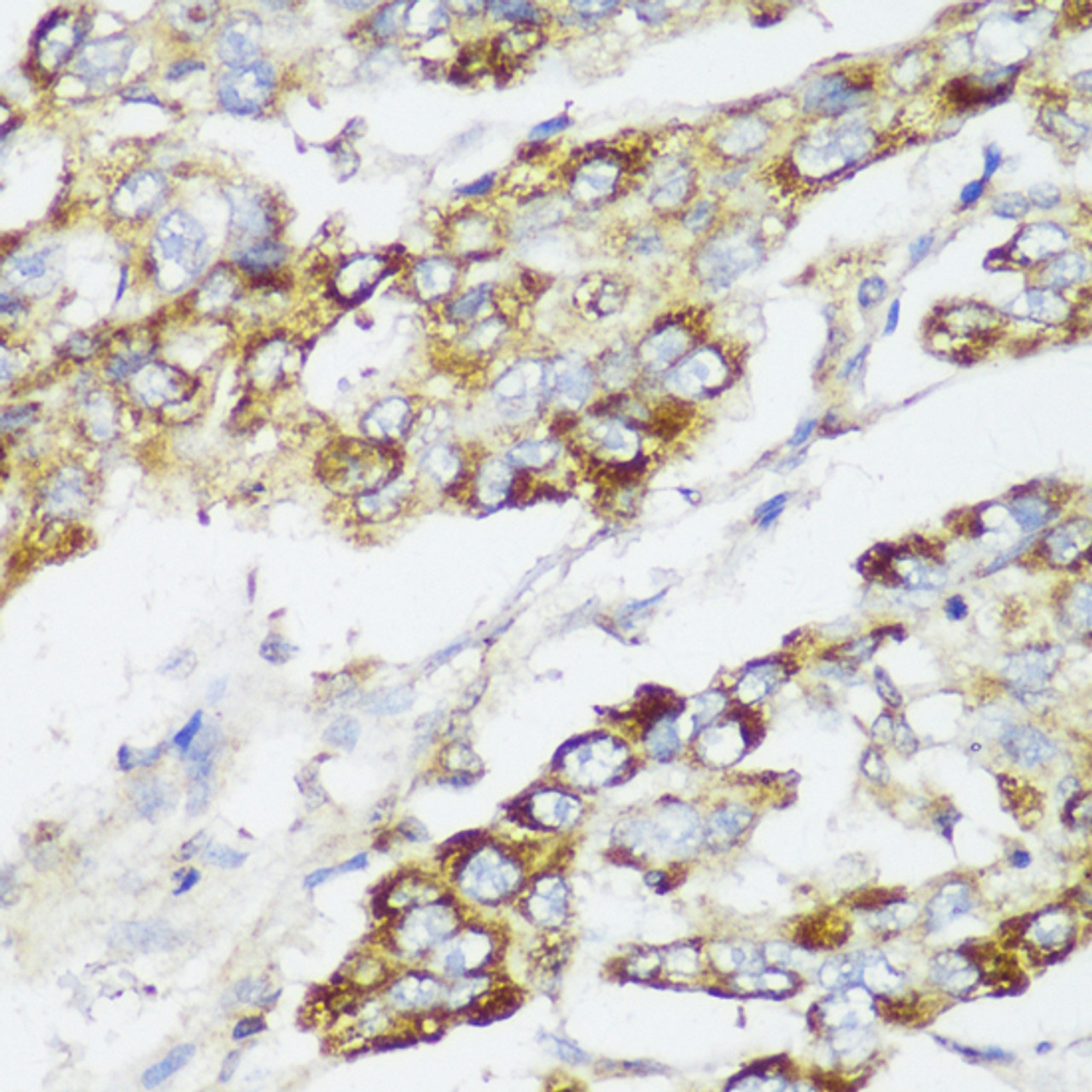 Immunohistochemistry of paraffin-embedded Human liver cancer using ECI2 Polyclonal Antibody at dilution of  1:150 (40x lens).