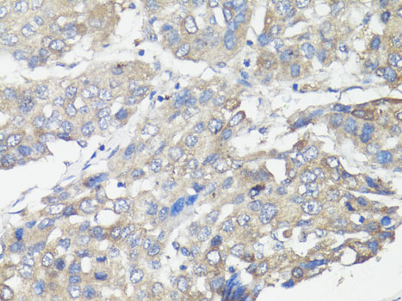 Immunohistochemistry of paraffin-embedded Human liver cancer using MUL1 Polyclonal Antibody at dilution of  1:100 (40x lens).