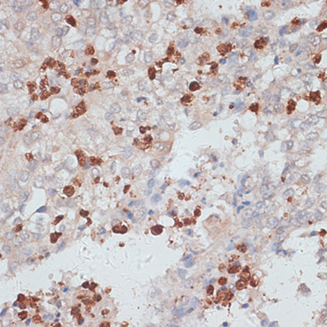 Immunohistochemistry of paraffin-embedded Human uterine cancer using CTSG Polyclonal Antibody at dilution of  1:100 (40x lens).