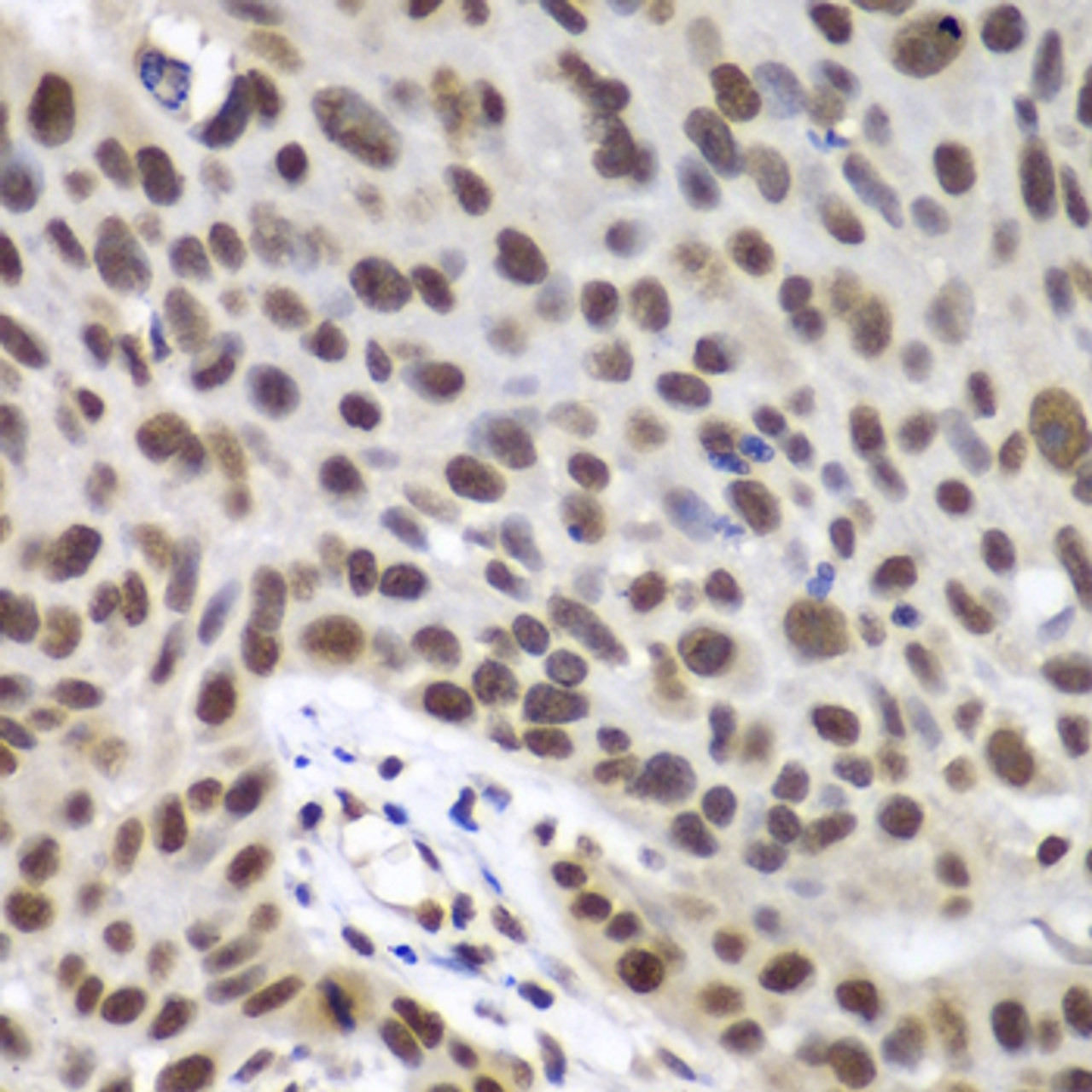 Immunohistochemistry of paraffin-embedded Human lung cancer using DDX5 Polyclonal Antibody at dilution of  1:100 (40x lens).