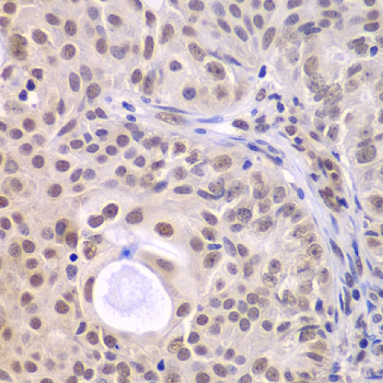 Immunohistochemistry of paraffin-embedded Human oophoroma using DDX5 Polyclonal Antibody at dilution of  1:100 (40x lens).