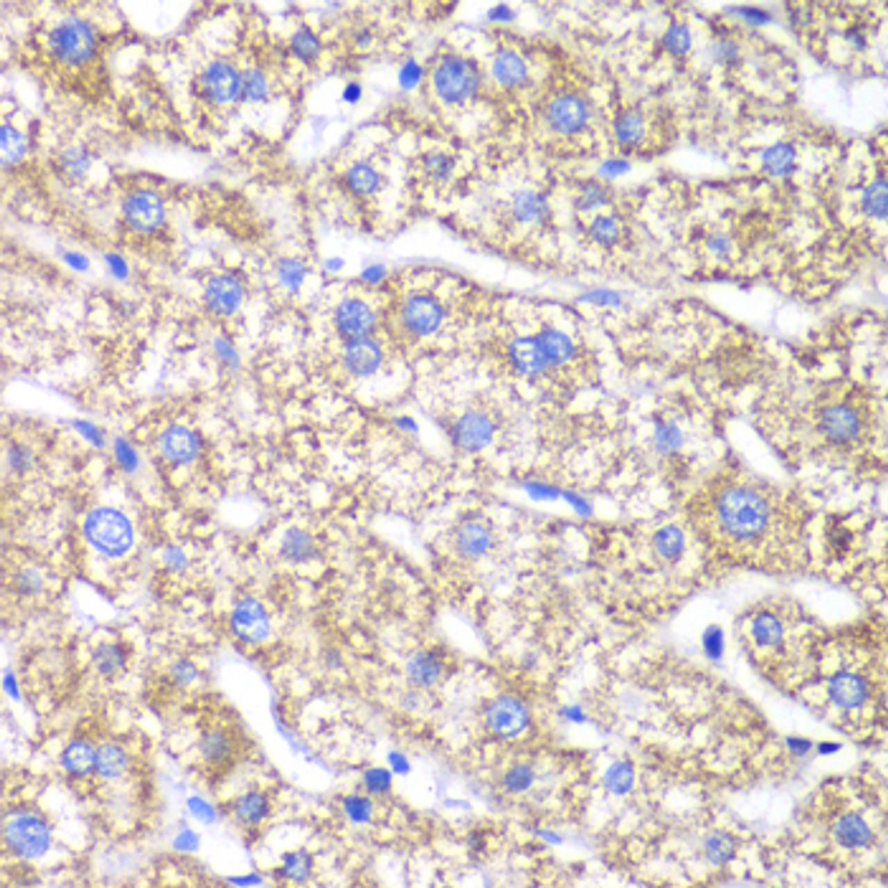 Immunohistochemistry of paraffin-embedded Human liver damage using DLST Polyclonal Antibody at dilution of  1:100 (40x lens).