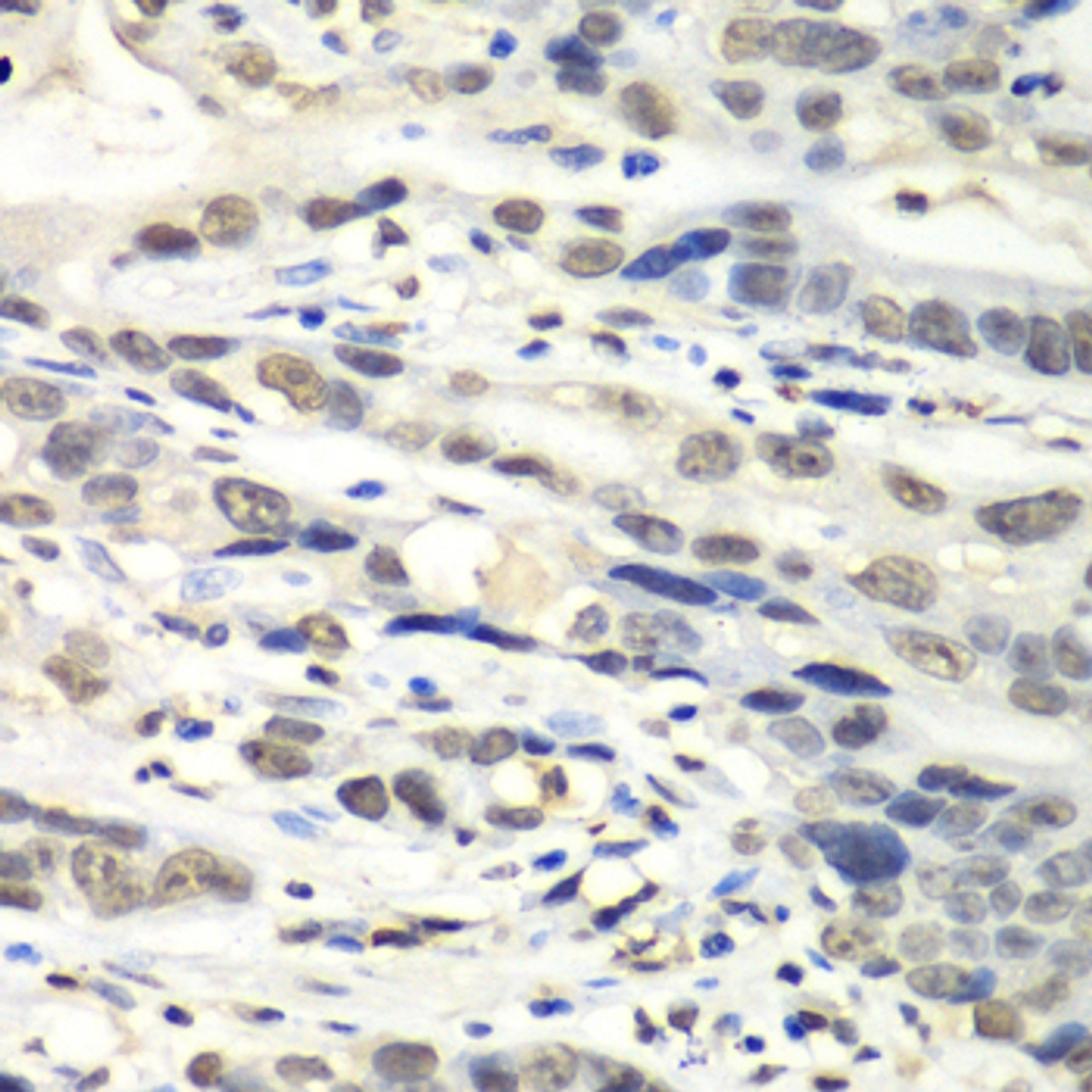 Immunohistochemistry of paraffin-embedded Human gastric cancer using NUDT1 Polyclonal Antibody at dilution of  1:100 (40x lens).