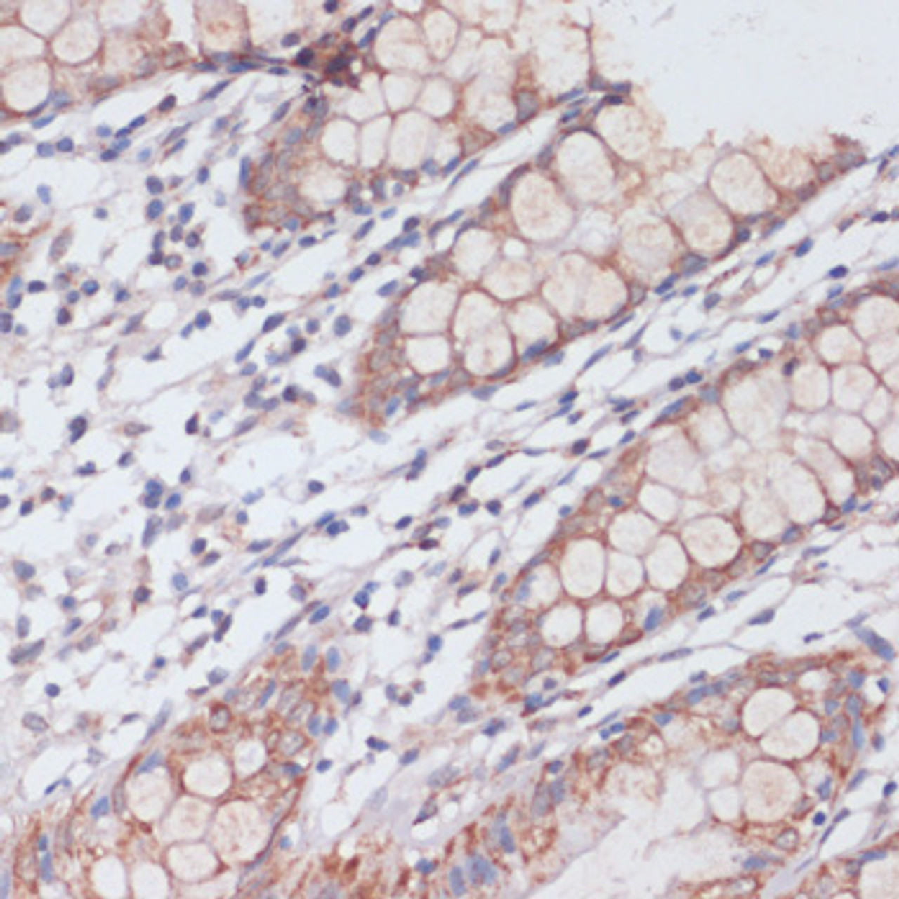Immunohistochemistry of paraffin-embedded Human colon using MBTPS1 Polyclonal Antibody at dilution of  1:100 (40x lens).