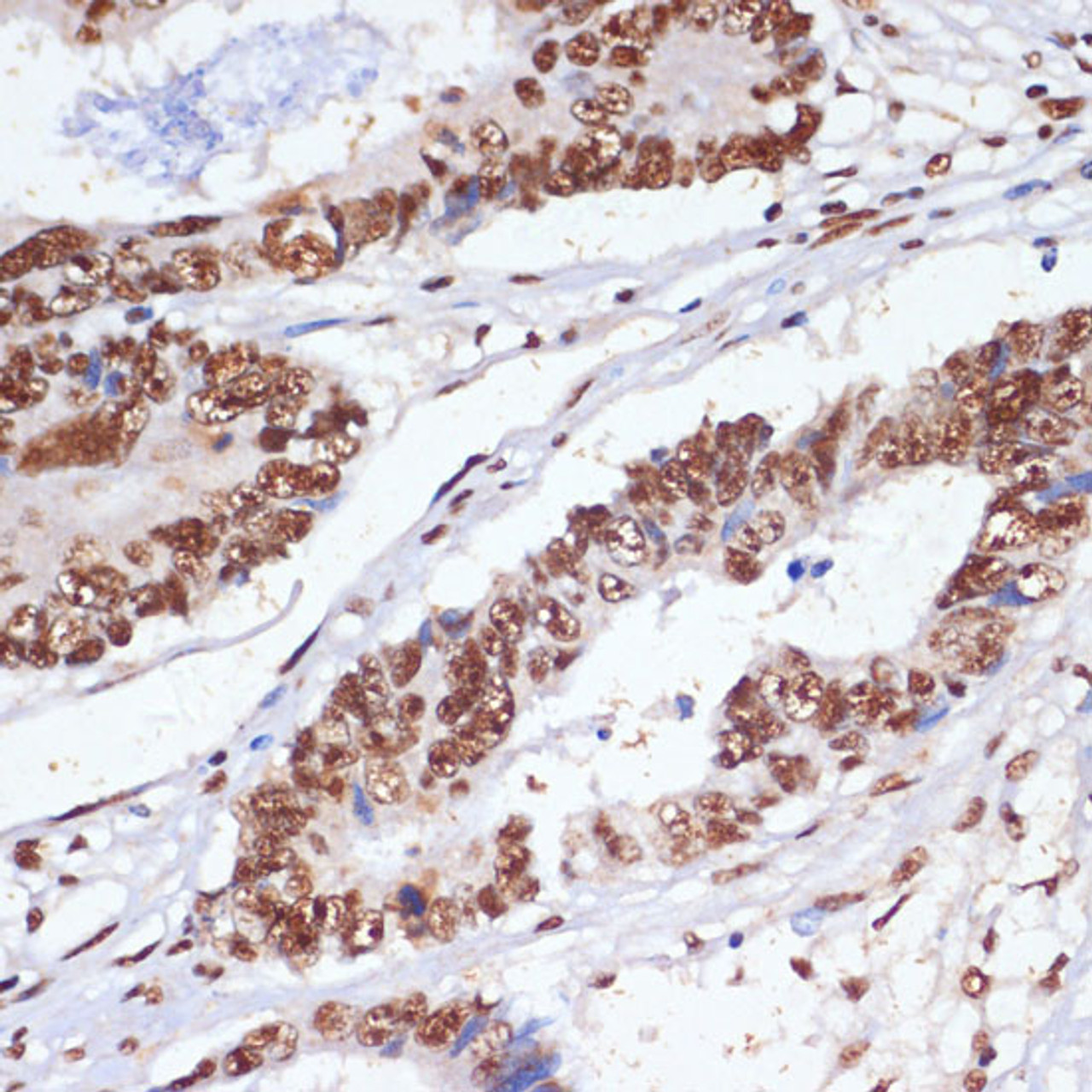 Immunohistochemistry of paraffin-embedded Human colon carcinoma using PELP1 Polyclonal Antibody at dilution of  1:100 (40x lens).