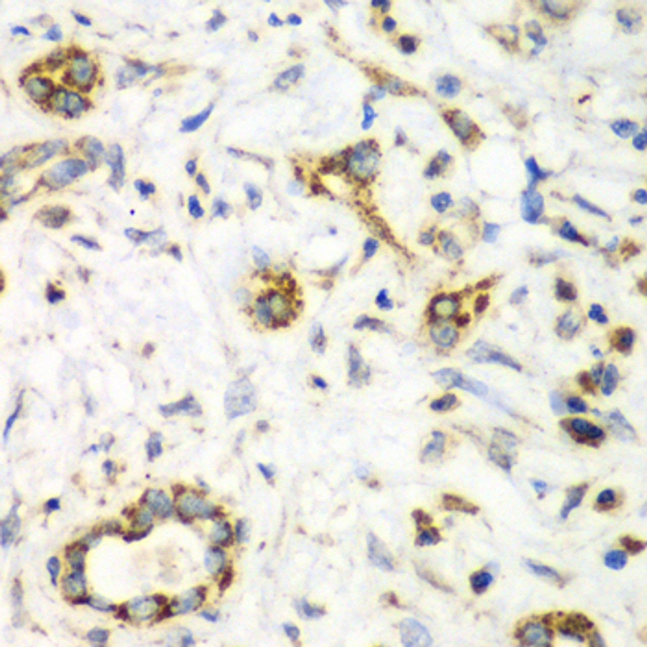 Immunohistochemistry of paraffin-embedded Human liver cancer using NRBF2 Polyclonal Antibody at dilution of  1:100 (40x lens).