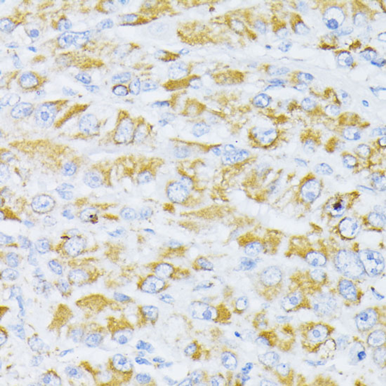 Immunohistochemistry of paraffin-embedded Human liver cancer using Cytochrome c Polyclonal Antibody at dilution of  1:100 (40x lens).