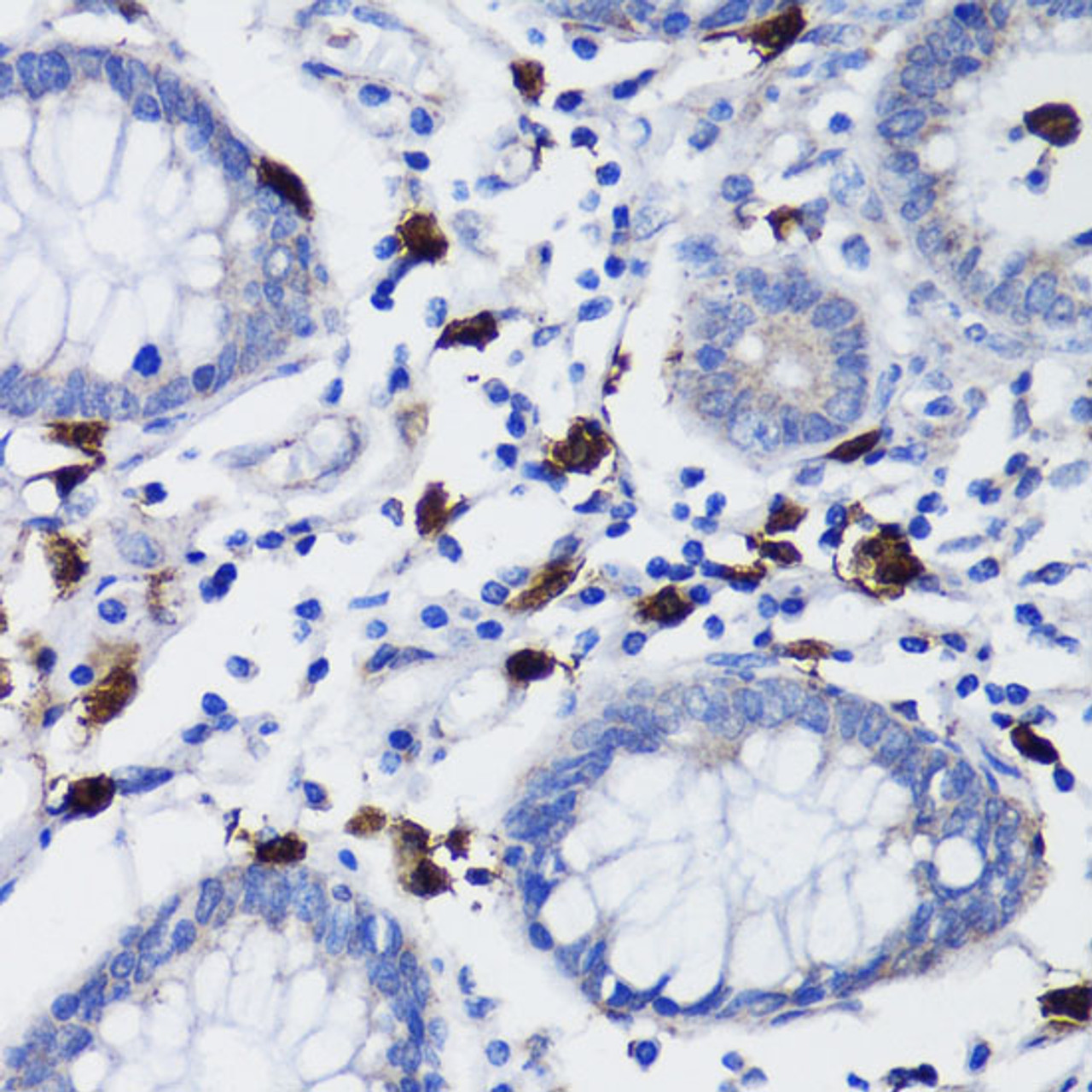 Immunohistochemistry of paraffin-embedded Human colon carcinoma using TET3 Polyclonal Antibody at dilution of  1:200 (40x lens).