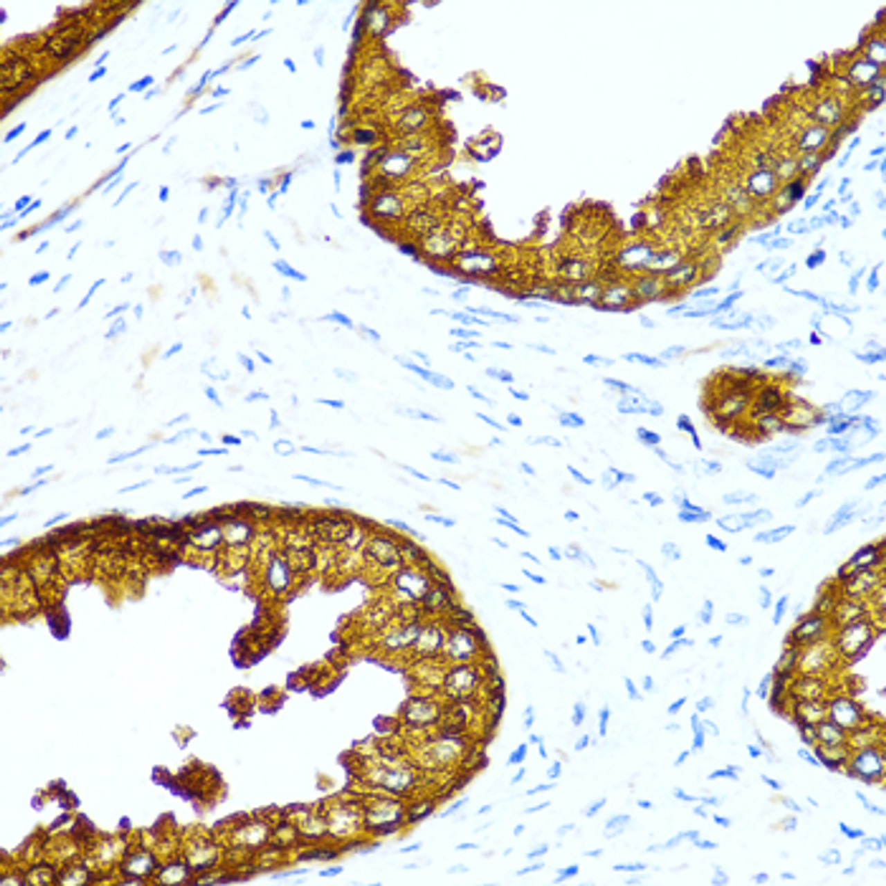 Immunohistochemistry of paraffin-embedded Human prostate using ACPP Polyclonal Antibody at dilution of  1:100 (40x lens).