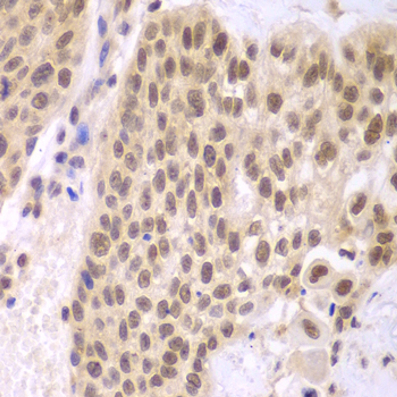 Immunohistochemistry of paraffin-embedded Human lung cancer using CSNK2A2 Polyclonal Antibody at dilution of  1:100 (40x lens).