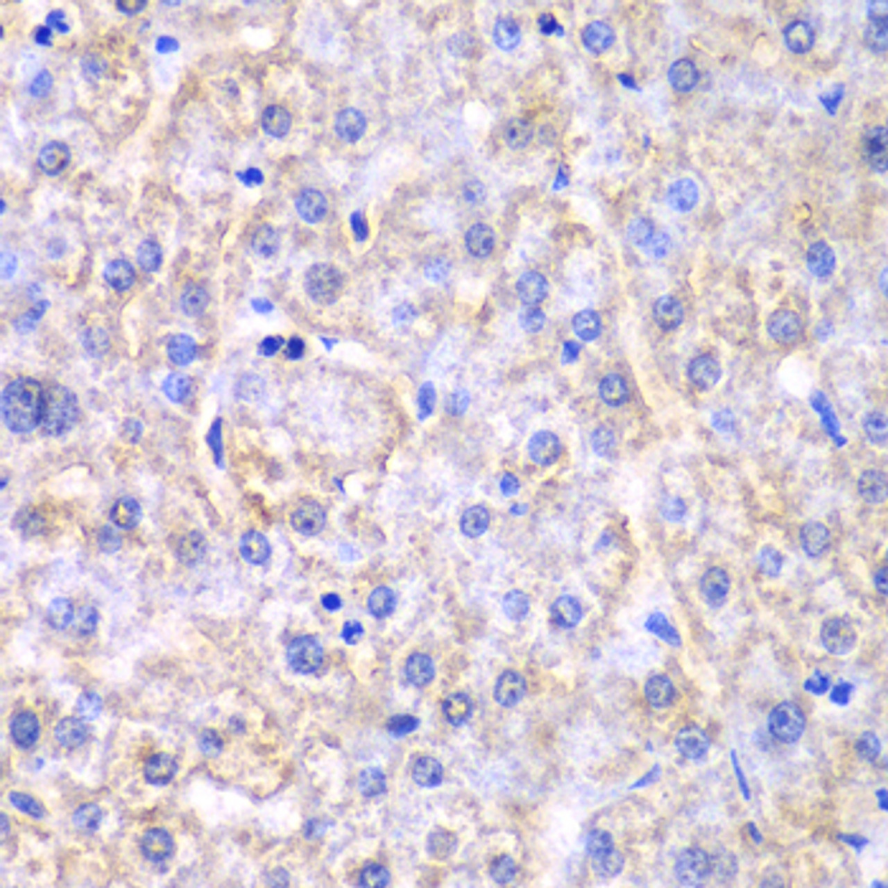 Immunohistochemistry of paraffin-embedded Human liver damage using EHHADH Polyclonal Antibody at dilution of  1:100 (40x lens).