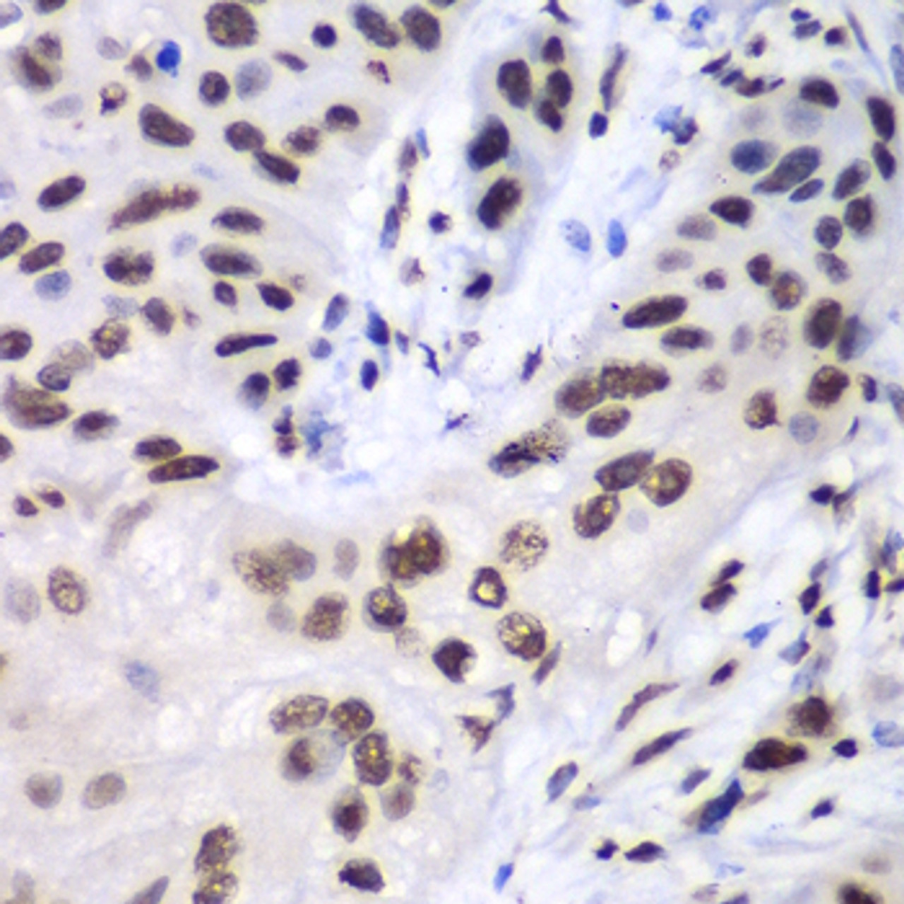 Immunohistochemistry of paraffin-embedded Human esophageal cancer using LIG3 Polyclonal Antibody at dilution of  1:100 (40x lens).