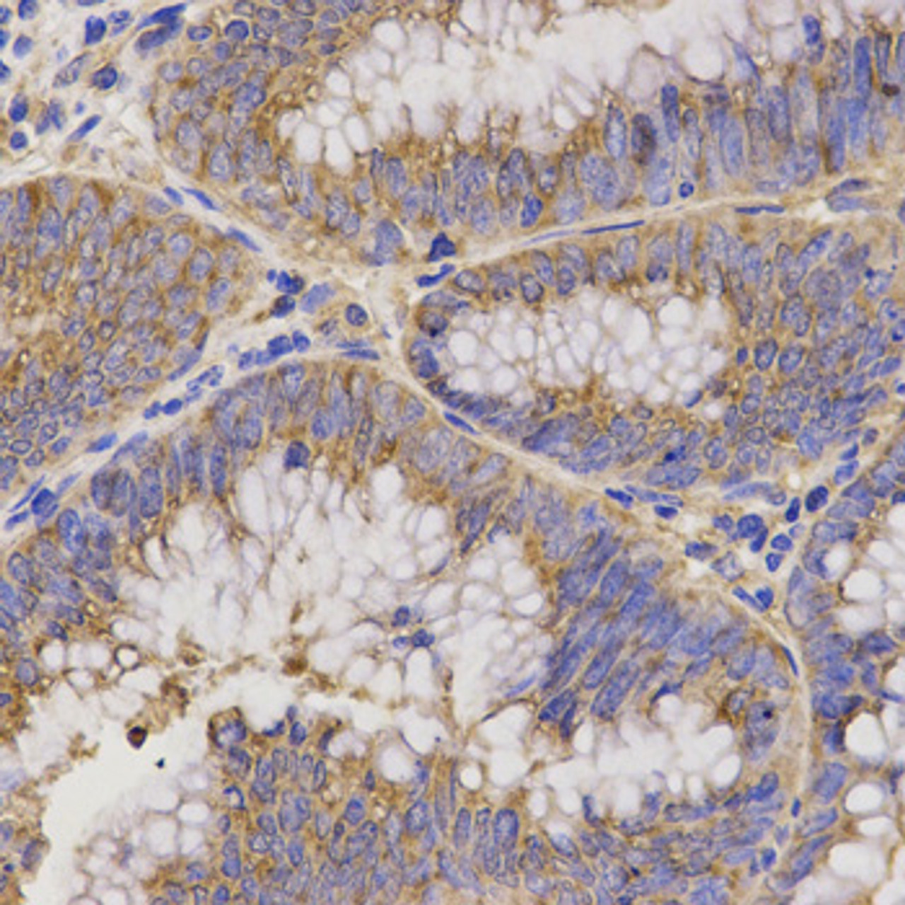 Immunohistochemistry of paraffin-embedded Human rectal cancer using TNFRSF1B Polyclonal Antibody at dilution of  1:200 (40x lens).